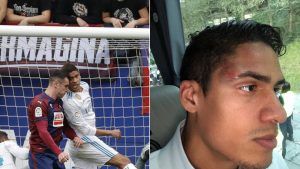 Así ha quedado la cara de Varane tras el fortuito choque