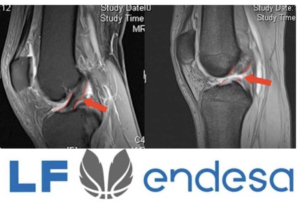 Rotura Ligamento cruzado anterior, Liga Femenina Endesa